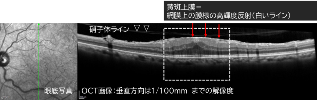 黄斑上膜の症状がわかる眼底写真とOCT画像｜松風たかぎ眼科