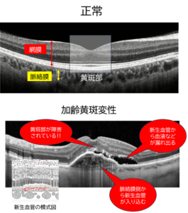 正常な状態と加齢黄斑変性になっている状態との比較。異常が生じると黄斑部が盛り上がり、網膜と脈絡膜の間に隙間が生じたりしています。そのため新生血管から血液などが漏れ出たり、脈絡膜側から新生血管が入り込んでしまったりします。（松風たかぎ眼科）