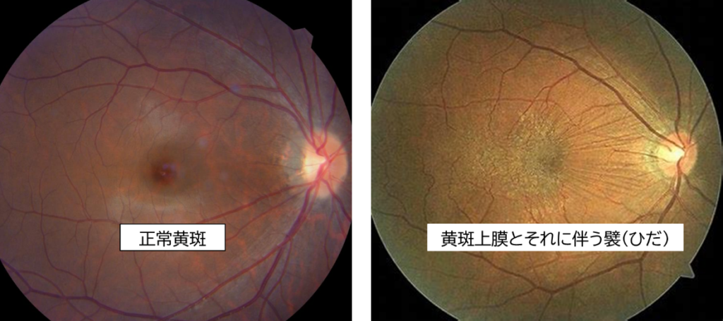 正常の黄斑と黄斑上膜が発症した際の比較画像｜松風たかぎ眼科