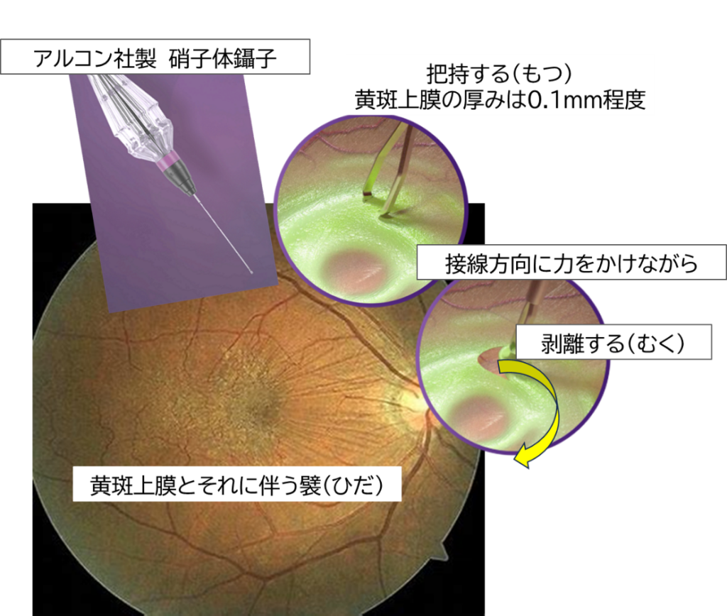 黄斑上膜の手術手順イメージ｜松風たかぎ眼科
