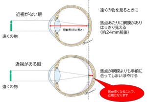 近視の仕組みについて、近視の無い人の眼の状態と並べて、焦点位置のズレを図解しています。近視の人は網膜よりも手前に焦点があり、そのため遠くがぼやけやすい状態になっています。（松風たかぎ眼科）