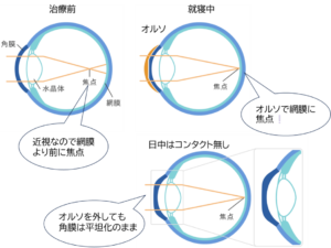 オルソケラトロジーを利用した治療の流れのイメージ図です。治療前は角膜がアーチ型になっていますが、就寝中にコンタクトにて矯正を行い、表面の角膜を変形し調整することで、起床してコンタクトを外した後も焦点の位置を正常な位置にできるという仕組みになっています。（松風たかぎ眼科）