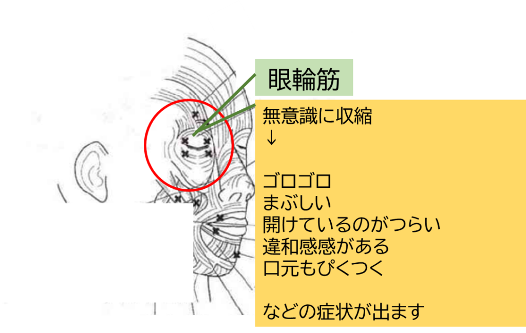眼瞼けいれんの症状の出方