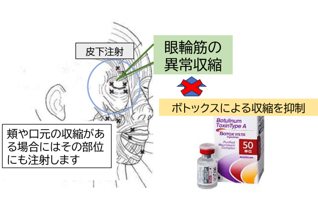 ボトックス治療と処置部位など