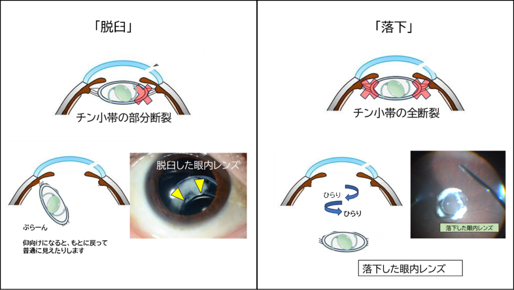 眼内レンズの脱臼や落下の仕組み
