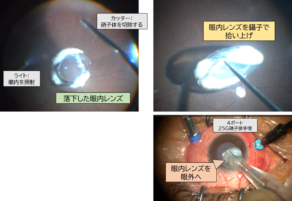 落下した眼内レンズを取り出すステップ