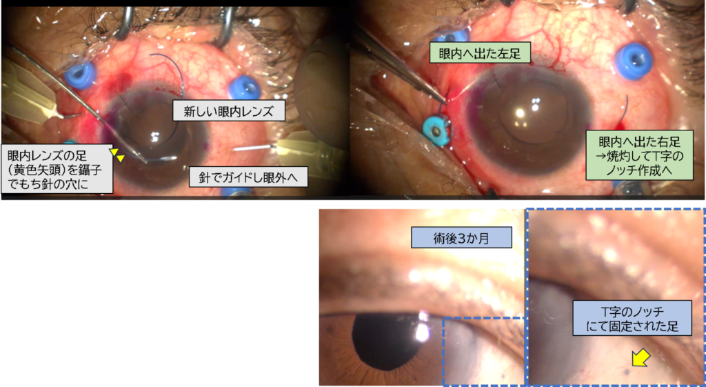 眼内レンズの挿入・固定のステップ～術後経過イメージ