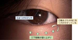 子どもに見られる内反症例