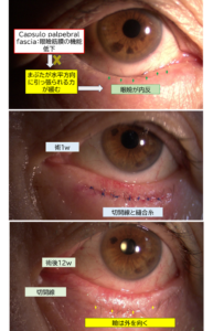 高齢者に多い内反症の術後経過事例