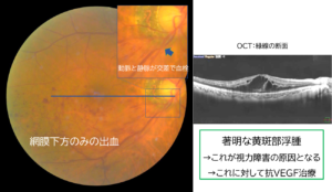 BRVOが起きている目の内部症例