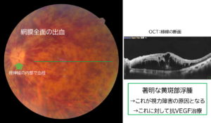 CRVOの症状が出ている目の内部症例